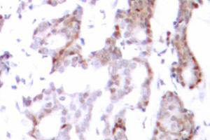 Immunohistochemistry (IHC) analysis of Elk1 antibody in paraffin-embedded human breast carcinoma tissue.
