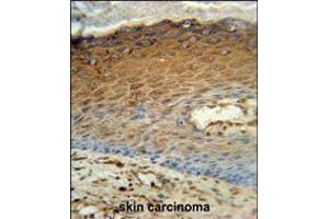 AK7 Antibody immunohistochemistry analysis in formalin fixed and paraffin embedded human skin carcinoma followed by peroxidase conjugation of the secondary antibody and DAB staining.