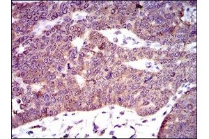 Immunohistochemical analysis of paraffin-embedded ovarian cancer tissues using PDE1B mouse mAb with DAB staining. (PDE1B antibody  (AA 370-536))