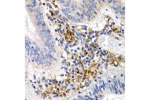 Immunohistochemistry of paraffin-embedded human colon cancer using GDF5 antibody at dilution of 1:200 (400x lens). (GDF5 antibody)