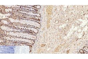 Immunohistochemistry of paraffin-embedded Human colon tissue using CD2 Monoclonal Antibody at dilution of 1:200. (CD2 antibody)