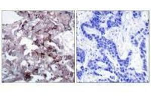 Immunohistochemistry analysis of paraffin-embedded human breast carcinoma tissue, using EGFR (Ab-1172) antibody. (EGFR antibody  (Tyr1172))