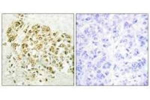 Immunohistochemistry analysis of paraffin-embedded human breast carcinoma tissue using MZF-1 antibody. (MZF1 antibody  (N-Term))
