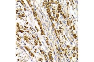 Immunohistochemistry of paraffin-embedded human stomach cancer using TACR3 antibody. (TACR3 antibody)