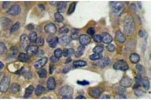 Immunohistochemistry (IHC) analyzes of p-ASK1 antibody in paraffin-embedded human breast carcinoma tissue (ASK1 antibody  (pSer966))
