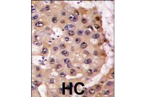 Formalin-fixed and paraffin-embedded human hepatocarcinoma tissue reacted with PSMA5 antibody , which was peroxidase-conjugated to the secondary antibody, followed by DAB staining.