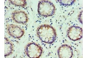 Immunohistochemistry of paraffin-embedded human colon cancer using ABIN7156617 at dilution of 1:100 (IRF2 antibody  (AA 120-349))
