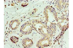 Immunohistochemistry of paraffin-embedded human breast cancer using ABIN7145038 at dilution of 1:100 (ATAD3A antibody  (AA 1-240))