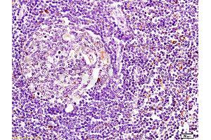 Formalin-fixed human pancreatic cancer tissue labeled with Anti-HLA DM? (CD74 antibody  (AA 201-296))