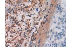 Detection of MAEA in Human Skin cancer Tissue using Polyclonal Antibody to Macrophage Erythroblast Attacher (MAEA) (MAEA antibody  (AA 136-379))