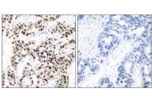 Immunohistochemical analysis of paraffin-embedded human breast carcinoma tissue using Myc (Ab-58) antibody (E021034). (c-MYC antibody)