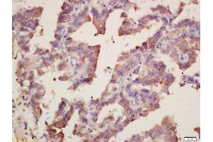 Formalin-fixed and paraffin embedded human lung carcinoma labeled with Rabbit Anti-SOD1 Polyclonal Antibody, Unconjugated  at 1:200 followed by conjugation to the secondary antibody and DAB staining (SOD1 antibody  (AA 6-100))
