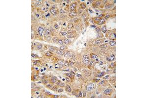 Formalin-fixed and paraffin-embedded human hepatocarcinoma tissue reacted with PGK1 antibody , which was peroxidase-conjugated to the secondary antibody, followed by DAB staining.