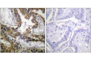 Immunohistochemistry analysis of paraffin-embedded human lung carcinoma tissue, using VEGFR2 (Ab-1054) Antibody.