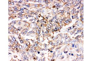 Anti-Smad1 antibody, IHC(P) IHC(P): Human Lung Cancer Tissue (SMAD1 antibody  (C-Term))