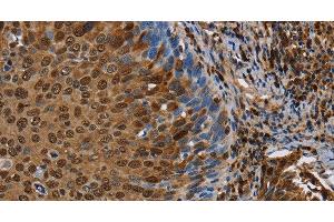 Immunohistochemistry of paraffin-embedded Human cervical cancer tissue using NRP2 Polyclonal Antibody at dilution 1:45 (NRP2 antibody)