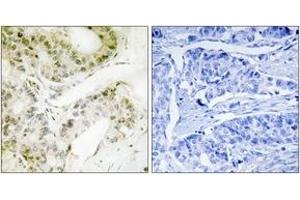 Immunohistochemistry analysis of paraffin-embedded human lung carcinoma, using MED13 Antibody. (MED13 antibody  (AA 681-730))