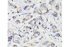 Immunohistochemistry of paraffin-embedded Human gastric cancer using PDCD10 Polyclonal Antibody at dilution of 1:100 (40x lens). (PDCD10 antibody)