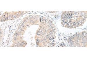 Immunohistochemistry of paraffin-embedded Human colorectal cancer tissue using LYRM2 Polyclonal Antibody at dilution of 1:50(x200) (LYRM2 antibody)