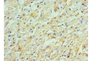 Immunohistochemistry of paraffin-embedded human liver cancer using ABIN7143180 at dilution of 1:100 (ACVR2A antibody  (AA 20-140))