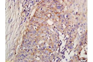Formalin-fixed and paraffin embedded human lung carcinoma labeled with Rabbit Anti-Factor D/Adipsin Polyclonal Antibody, Unconjugated (ABIN1713782) at 1:200 followed by conjugation to the secondary antibody and DAB staining (Adipsin antibody  (AA 21-120))