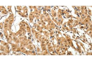 Immunohistochemistry of paraffin-embedded Human lung cancer tissue using MAP1A Polyclonal Antibody at dilution 1:40 (MAP1A antibody)