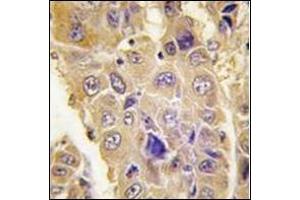 Formalin-fixed and paraffin-embedded human hepatocarcinoma tissue reacted with  Autophagy ATG7 (C-term) followed which was peroxidase-conjugated to the secondary antibody, followed by DAB staining. (ATG7 antibody  (C-Term))