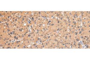 Immunohistochemistry of paraffin-embedded Human liver cancer using AP2A1 Polyclonal Antibody at dilution of 1/20 (alpha Adaptin antibody)