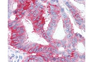 Anti-GPR31 antibody IHC of human Colon, Carcinoma. (GPR31 antibody  (Extracellular Domain))