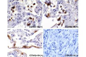 Immunohistochemical analysis of paraffin-embedded COVID-19 patient lung tissue using anti-SARS-CoV-2 (COVID-19) Spike S2 antibody (ABIN1030641, 0. (SARS-CoV-2 Spike antibody  (C-Term))
