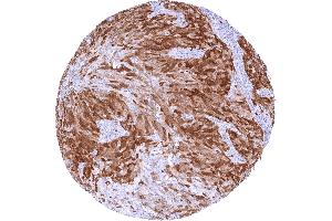 Urothelial carcinoma of the urinary bladder Invasive with moderate to strong TYMS staining of tumor cells