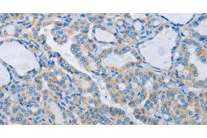Immunohistochemistry of paraffin-embedded Human thyroid cancer tissue using NEK5 Polyclonal Antibody at dilution 1:60 (NEK5 antibody)