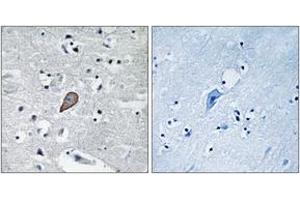 Immunohistochemistry analysis of paraffin-embedded human brain carcinoma tissue, using PKC thet (Ab-538) Antibody.