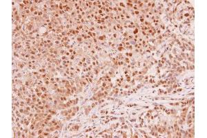 IHC-P Image MAD2L1 antibody [C2C3], C-term detects MAD2L1 protein at cytoplasm and nucleus in human A549 xenograft by immunohistochemical analysis. (MAD2L1 antibody  (C-Term))