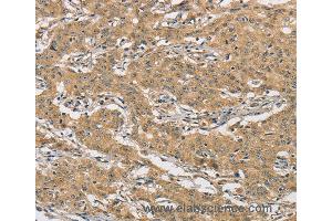 Immunohistochemistry of Human liver cancer using AMZ2 Polyclonal Antibody at dilution of 1:60