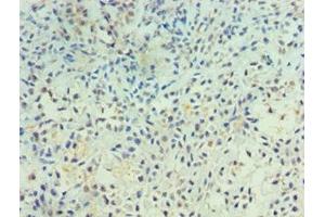 Immunohistochemistry of paraffin-embedded human breast cancer using ABIN7167500 at dilution of 1:100 (PTPRA antibody  (AA 20-142))