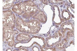 ABIN6267702 at 1/100 staining human kindey carcinoma tissue sections by IHC-P. (CAMK2B antibody  (pThr286))