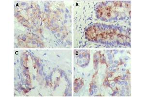 Immunohistochemical analysis of paraffin-embedded human lung cancer (A), recturn(B), prostate (C), colon cancer (D) showing cytoplasmic localization.