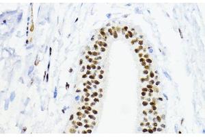 Immunohistochemistry of paraffin-embedded Human mammary cancer using ZEB1 Polyclonal Antibody at dilution of 1:200 (40x lens). (ZEB1 antibody)