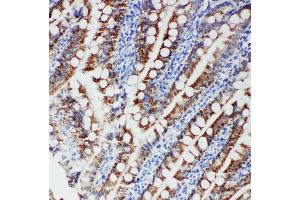 Anti-FER antibody, IHC(P) IHC(P): Human Intestinal Cancer Tissue (FER antibody  (Middle Region))