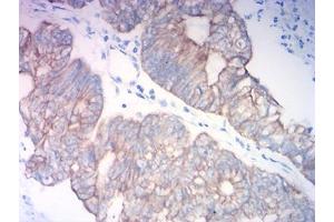 Immunohistochemical analysis of paraffin-embedded colon cancer tissues using KRT18 mouse mAb with DAB staining. (Cytokeratin 18 antibody  (AA 1-150))