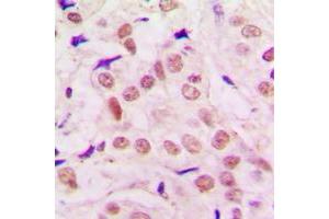 Immunohistochemical analysis of TRPS1 staining in human lung cancer formalin fixed paraffin embedded tissue section. (TRPS1 antibody  (N-Term))