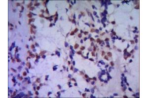 IHC of paraffin-embedded huma breast cancer using anti-TBLR1 mouse mAb diluted 1/500-1/1000 (TBL1XR1 antibody)