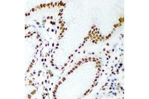Immunohistochemical analysis of RbAp46 staining in human gastric cancer formalin fixed paraffin embedded tissue section. (RBBP7 antibody)