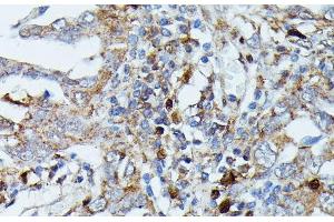 Immunohistochemistry of paraffin-embedded Human lung cancer using MAP3K3 Polyclonal Antibody at dilution of 1:100 (40x lens). (MAP3K3 antibody)