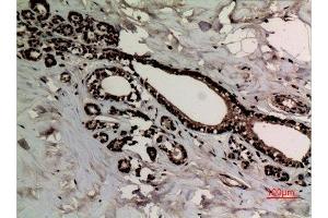 Immunohistochemistry (IHC) analysis of paraffin-embedded Human Breast Cancer, antibody was diluted at 1:100. (Histone 3 antibody  (2meLys10))