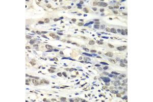 Immunohistochemistry of paraffin-embedded human gastric cancer using NUDT1 antibody (ABIN6292587) at dilution of 1:100 (40x lens).