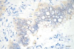 Immunohistochemistry was performed on paraffin-embedded human pancreatic adenocarcinoma using SBDS antibody (ABIN7800330), 1:200). (Recombinant SBDS antibody)