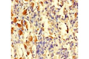 Immunohistochemistry of paraffin-embedded human melanoma using ABIN7166593 at dilution of 1:100 (TGFA antibody  (AA 40-89))