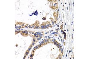 Immunohistochemistry of paraffin-embedded human stomach cancer using FABP3 antibody (ABIN5973057) at dilution of 1/200 (40x lens). (FABP3 antibody)